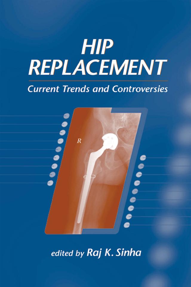 Hip Replacement by Raj K. Sinha
