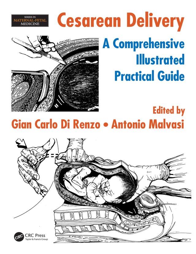 Cesarean Delivery by Antonio Malvasi, Gian Carlo Di Renzo