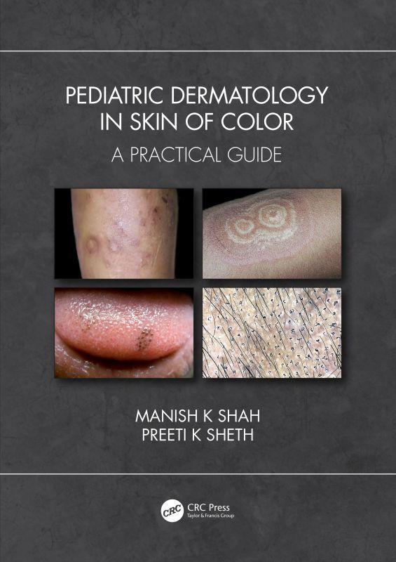 Pediatric Dermatology in Skin of Color by Manish K Shah, Preeti K Sheth