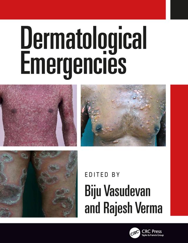 Dermatological Emergencies by Biju Vasudevan, Rajesh Verma