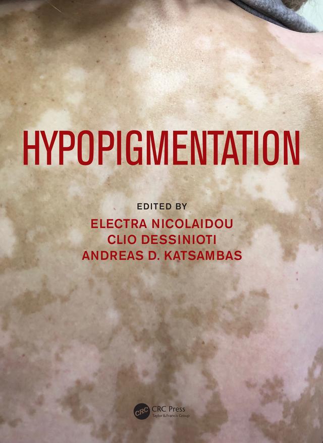 Hypopigmentation by Andreas Katsambas, Clio Dessinioti, Electra Nicolaidou