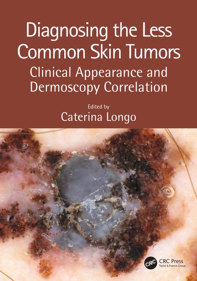 Diagnosing the Less Common Skin Tumors by Caterina Longo