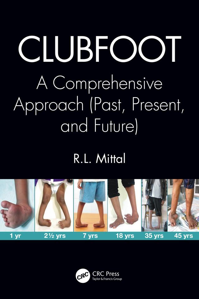 Clubfoot by R. L. Mittal