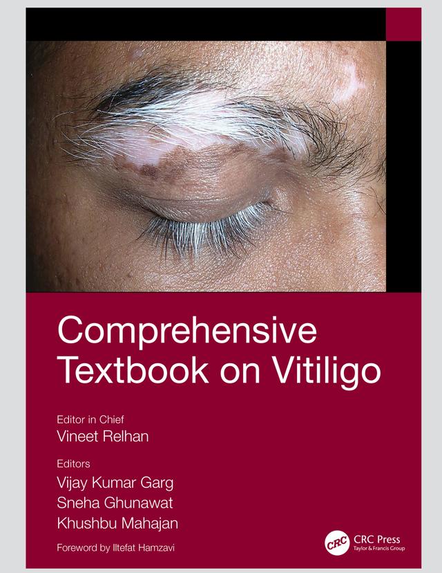 Comprehensive Textbook on Vitiligo by Khushbu Mahajan, Sneha Ghunawat, Vijay Kumar Garg, Vineet Relhan