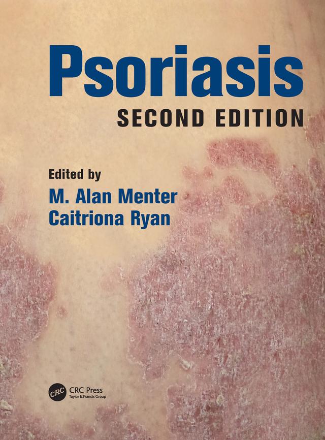 Psoriasis by Caitriona Ryan, M. Alan Menter