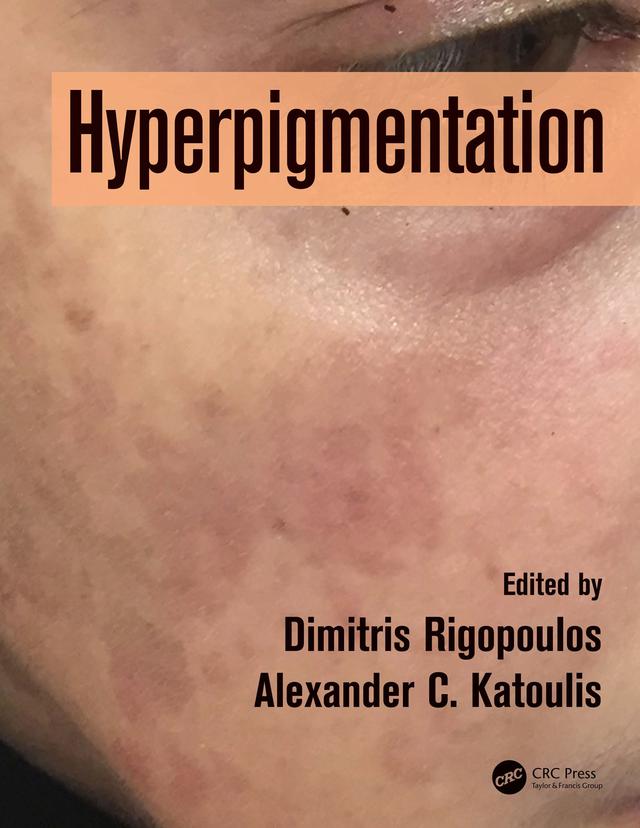 Hyperpigmentation by Alexander C. Katoulis, Dimitris Rigopoulos