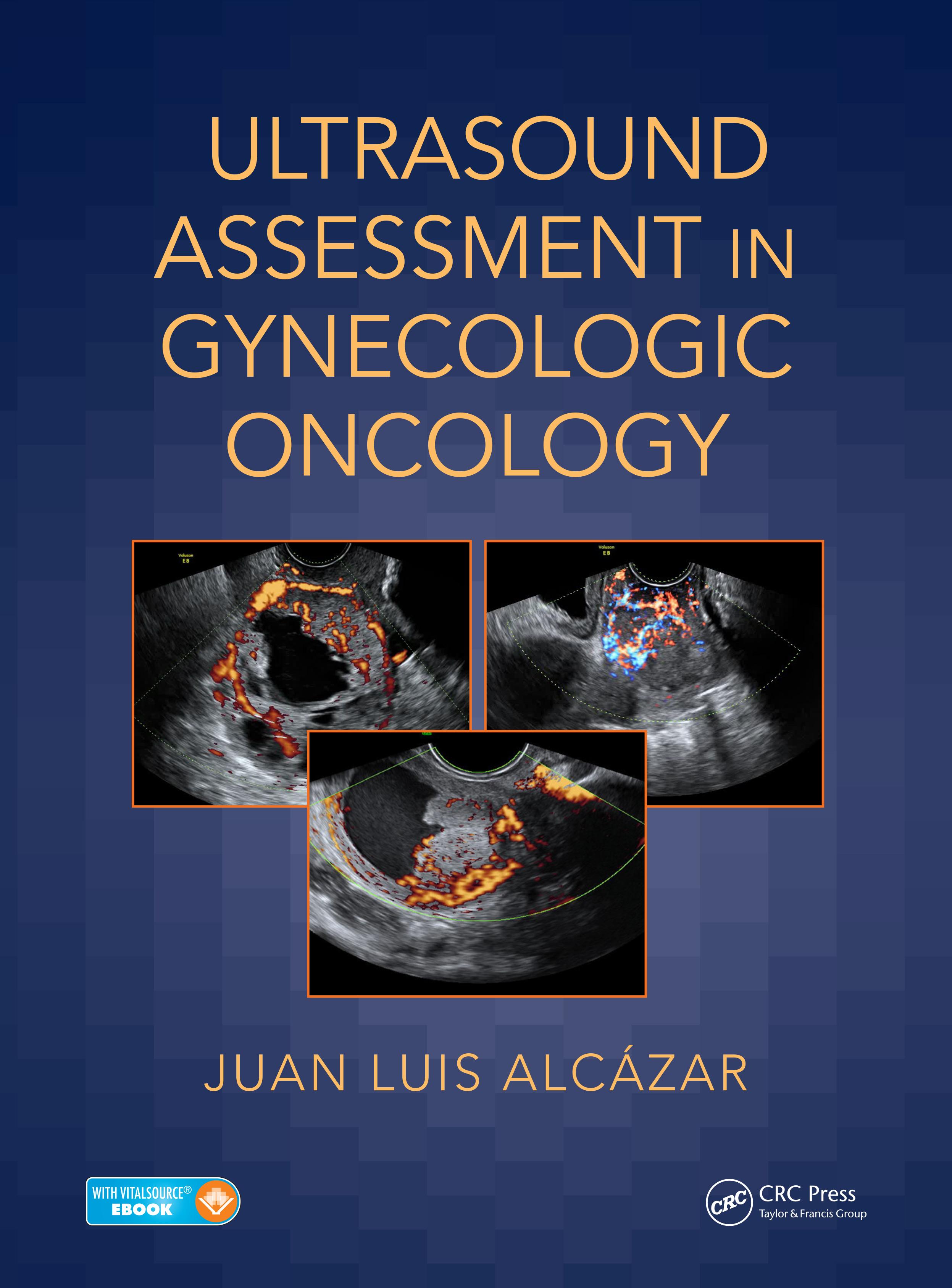 Ultrasound Assessment in Gynecologic Oncology