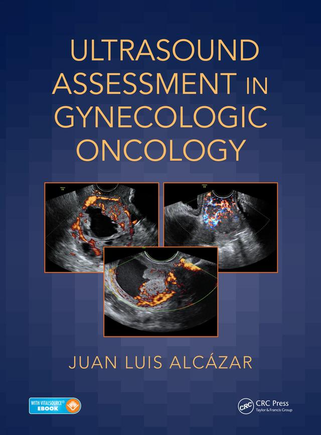 Ultrasound Assessment in Gynecologic Oncology by Juan Luis Alcázar