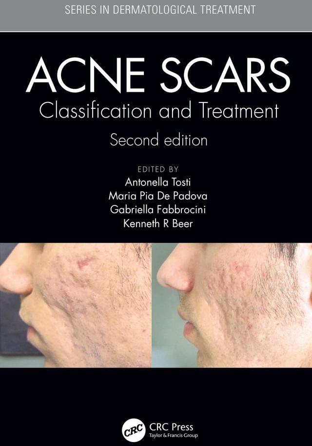 Acne Scars by Antonell Tosti, Gabriella Fabbrocini, Kenneth Beer, Maria Pia De Padova
