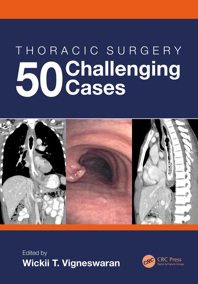 Thoracic Surgery: 50 Challenging cases by Wickii Vigneswaran