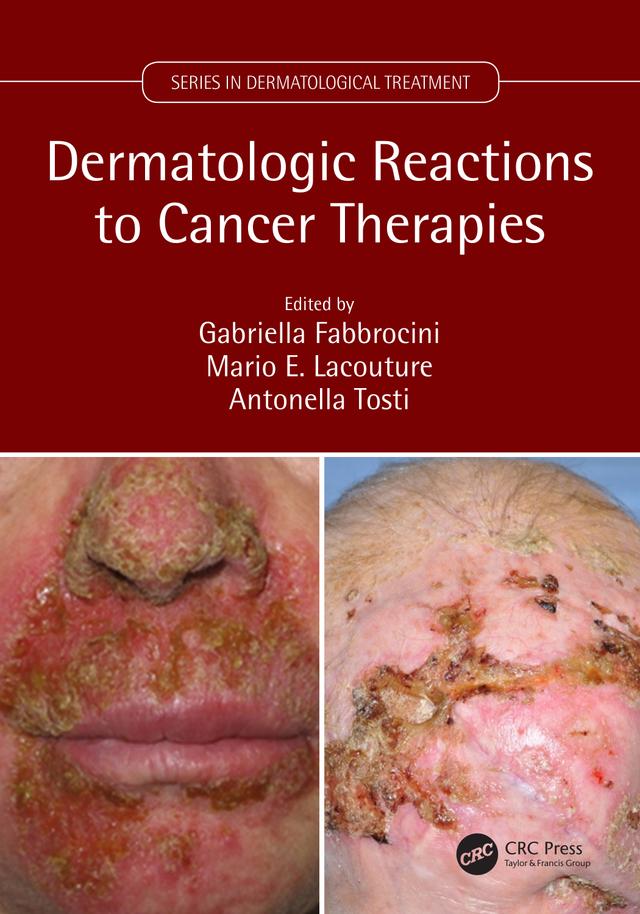 Dermatologic Reactions to Cancer Therapies by Antonella Tosti, Gabriella Fabbrocini, Mario Lacouture