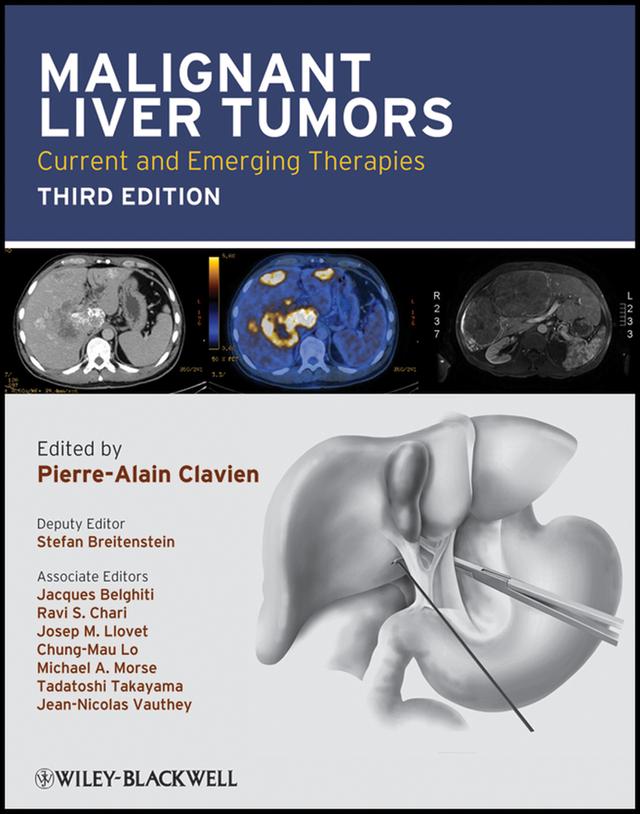 Malignant Liver Tumors by Chung-Mau Lo, Jacques Belghiti, Jean-Nicolas Vauthey, Josep M. Llovet, Michael A. Morse, Pierre-Alain Clavien, Ravi S. Chari, Stefan Breitenstein, Tadatoshi Takayama