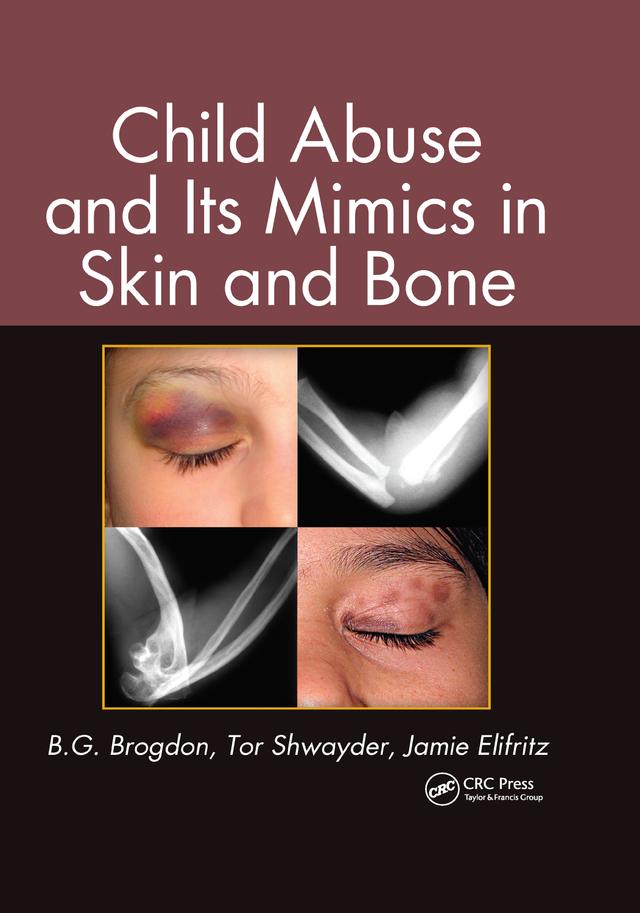 Child Abuse and its Mimics in Skin and Bone by B. G. Brogdon, Jamie Elifritz, Tor Shwayder