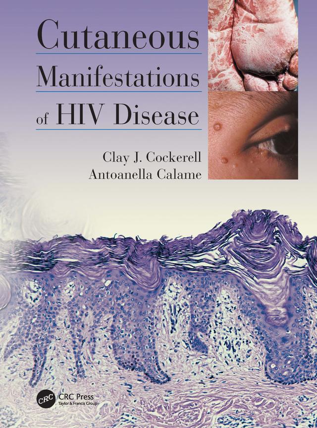Cutaneous Manifestations of HIV Disease by Antoanella Calame, Clay Cockerell