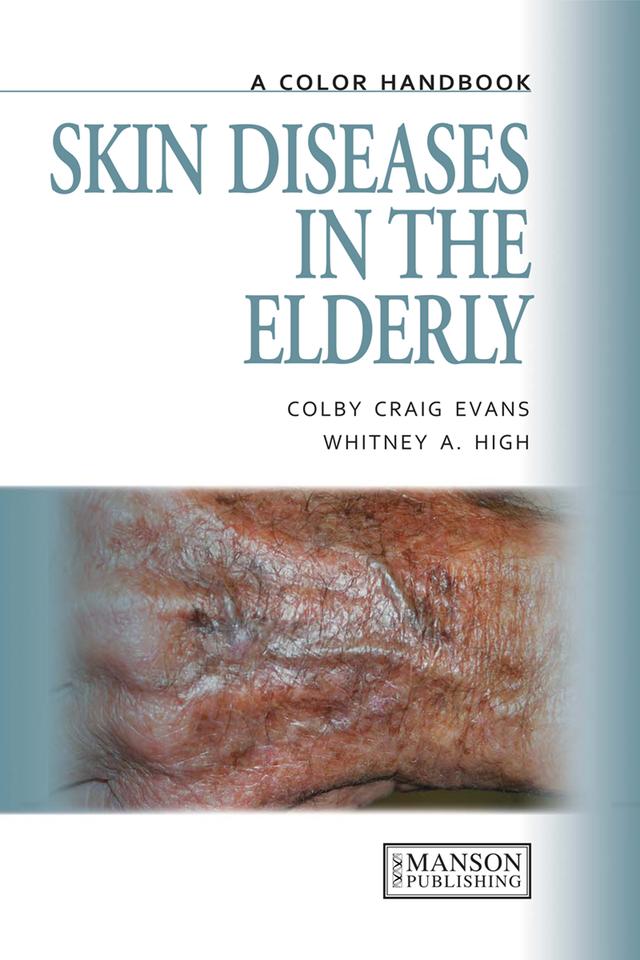 Skin Diseases in the Elderly by Colby Evans, Whitney High