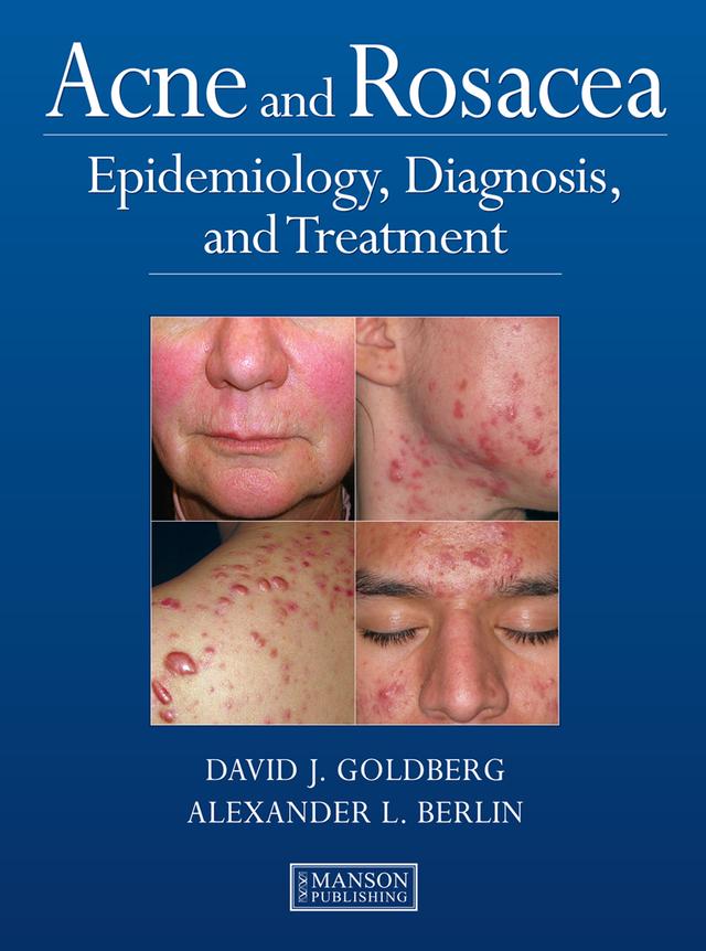 Acne and Rosacea by Alexander Berlin, David Goldberg