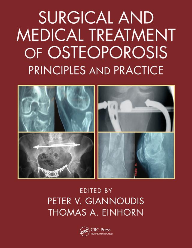 Surgical and Medical Treatment of Osteoporosis by Peter V. Giannoudis, Thomas A. Einhorn