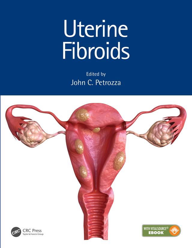 Uterine Fibroids by John C. Petrozza