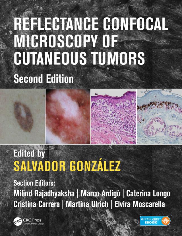Reflectance Confocal Microscopy of Cutaneous Tumors by Salvador Gonzalez