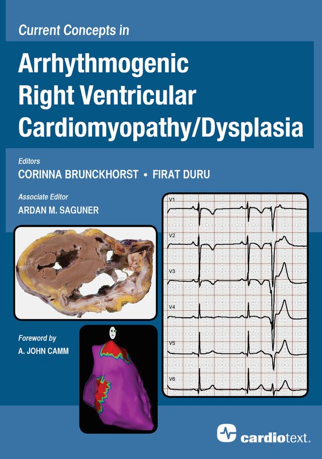 Current Concepts in Arrhythmogenic Right Ventricular Cardiomyopathy/Dysplasia by Dr. Ardan Saguner, Prof. Dr. Corinna Brunckhorst, Prof. Dr. Firat Duru