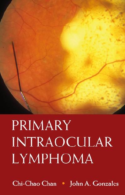 PRIMARY INTRAOCULAR LYMPHOMA